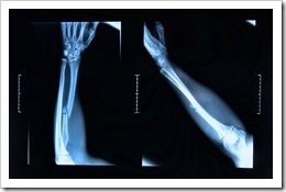 bone fracture